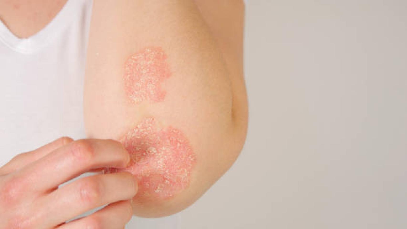 La psoriasis es una enfermedad infamatoria del sistema inmunitario que afecta a la piel.